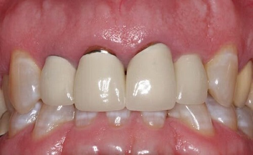 Bọc răng sứ bị thâm lợi là do đâu? Cần lời giải đáp