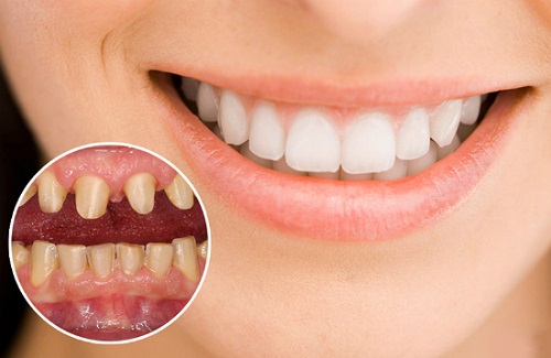 Bọc răng sứ không cần mài răng - Quy trình thực hiện