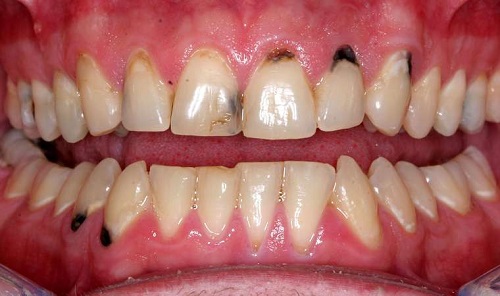 Bọc răng sứ titan có tốt không? Tìm hiểu chi tiết về răng sứ titan