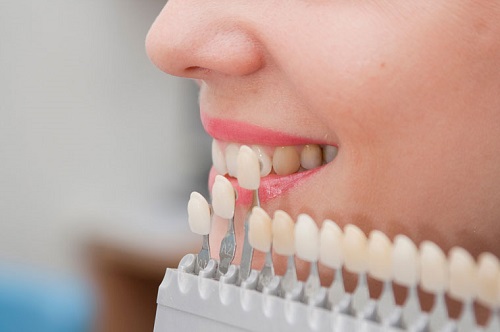 Bọc sứ răng cửa giá bao nhiêu? Có tùy thuộc vào vật liệu làm răng sứ không?
