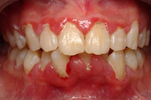 Niềng răng bị sưng lợi - Nguyên nhân và cách chữa trị