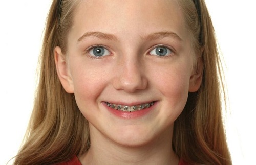 Niềng răng cho trẻ 10 tuổi phải lưu ý điều gì?