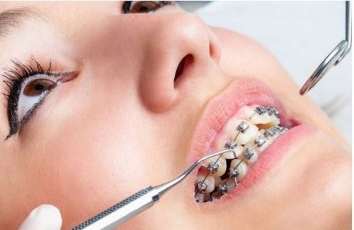 Niềng răng có hại cho sức khỏe không? Tìm hiểu ngay
