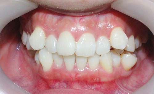 Niềng răng có phải nhổ răng không? Các trường hợp cần nhổ răng