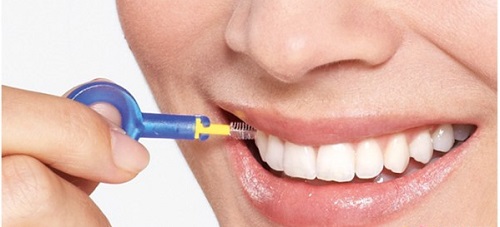 Niềng răng dùng bàn chải gì giúp vệ sinh răng miệng tốt?