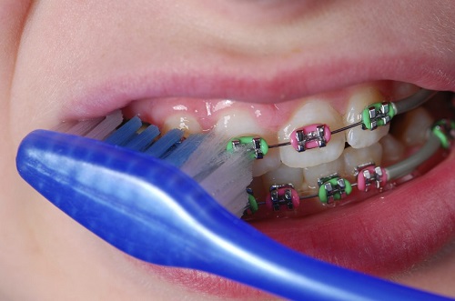 Niềng răng dùng bàn chải gì giúp vệ sinh răng miệng tốt?