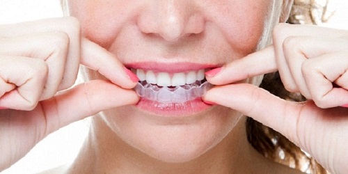 Dụng cụ niềng răng tại nhà có tốt không? Tham khảo	dụng cụ 3