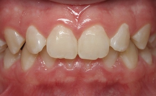 Niềng răng khớp cắn sâu là gì? Tìm hiểu cách khắc phục
