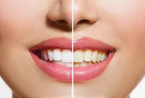 Có nên tẩy trắng răng nhiều lần không? Lý do chi tiết  1