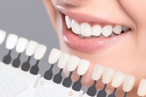 Có nên tẩy trắng răng nhiều lần không? Lý do chi tiết 2