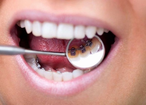 Niềng răng mặt trong mất bao lâu? Tìm hiểu kỹ thuật niềng răng 2