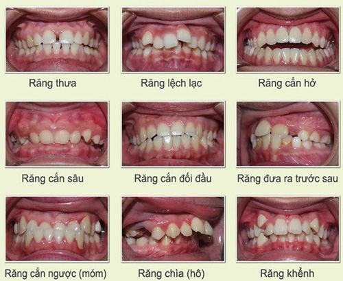 Niềng răng mặt trong mất bao lâu? Tìm hiểu kỹ thuật niềng răng 3