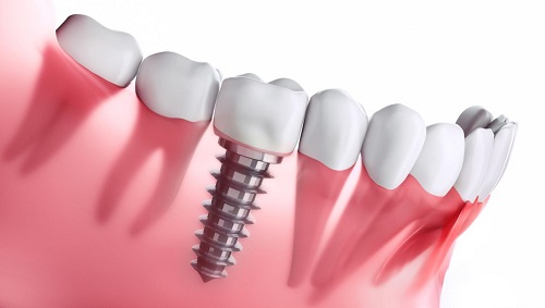 Trồng răng nên ăn gì? Thực đơn sau khi trồng răng cho bạn 2