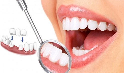 Trồng răng sứ có bền không? Nhờ chuyên gia giải đáp 2
