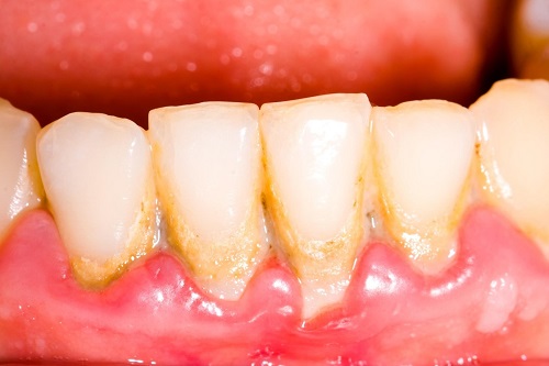 Lấy cao răng có ảnh hưởng không? Tìm hiểu ngay 1