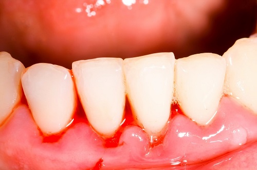 Lấy cao răng có ảnh hưởng không? Tìm hiểu ngay 2