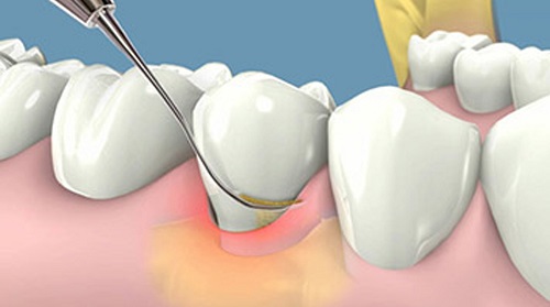 Lấy cao răng có đau hay không? Tìm hiểu cách thực hiện 1