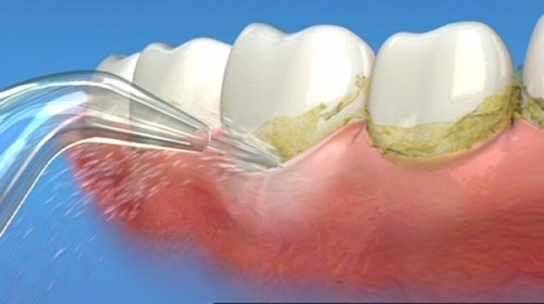 Lấy cao răng có đau hay không? Tìm hiểu cách thực hiện 2