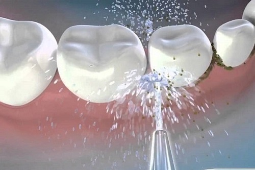 Lấy cao răng có đau hay không? Tìm hiểu cách thực hiện 3