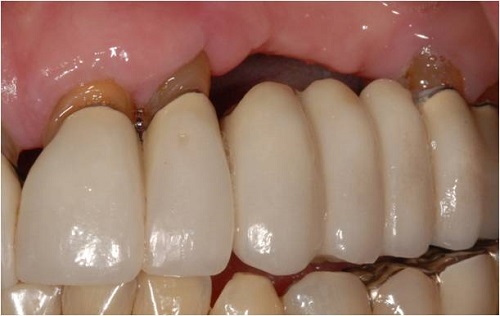 Răng sứ bị hỏng nên làm gì để khắc phục? 2