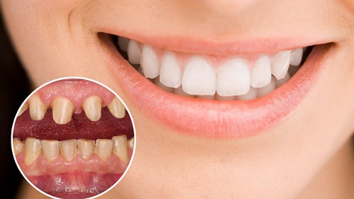 Răng sứ bị hỏng nên làm gì để khắc phục? 3