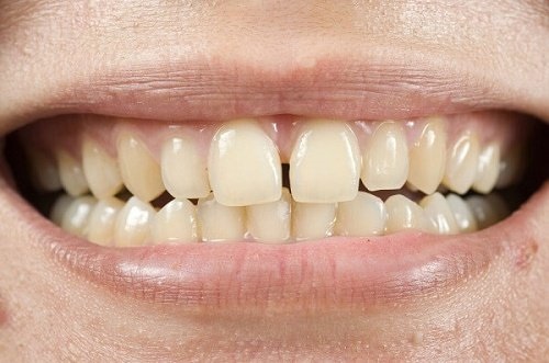 Răng sứ bị thưa là do đâu? 3 cách chữa răng sứ bị thưa 2