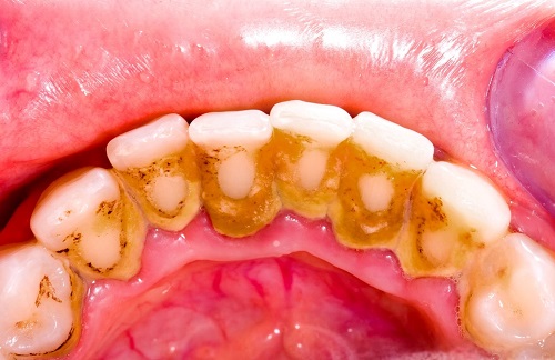 Lấy cao răng ở đâu an toàn? Tham khảo từ nha khoa 2