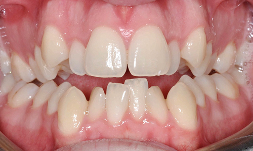 Niềng răng lộn xộn - Phương pháp giúp bạn phục hình 1