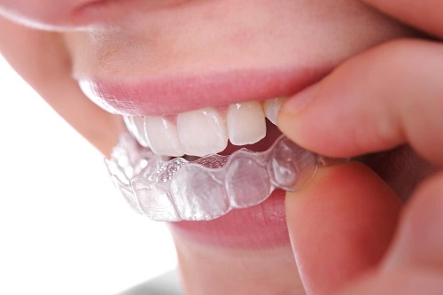 Niềng răng lộn xộn - Phương pháp giúp bạn phục hình 2