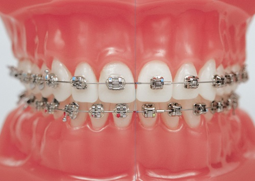 Niềng răng phải nhổ răng nào? Nha khoa giải đáp 1