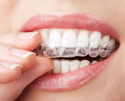 Niềng răng phải nhổ răng nào? Nha khoa giải đáp 2