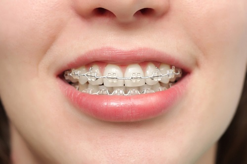 Niềng răng phải nhổ răng nào? Nha khoa giải đáp 3