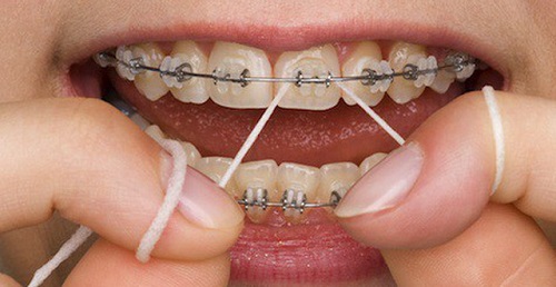 Niềng răng bị viêm lợi do đâu? Cách khắc phục hiệu quả 3