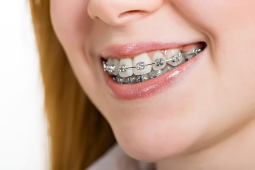Niềng răng bị viêm lợi do đâu? Cách khắc phục hiệu quả 2