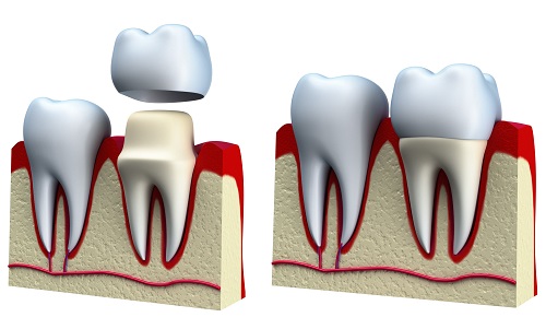 Bọc răng sứ zirconia - Tìm hiểu các thông tin liên quan 3