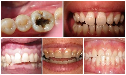 Bọc răng sứ có bị rớt ra không? Chia sẻ cách xử lý 2