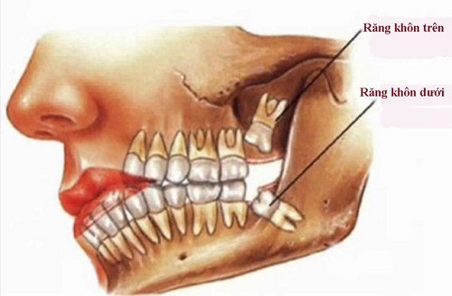 Nhổ 2 răng khôn hàm trên - Cảnh báo từ nha khoa 1