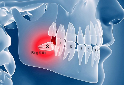 Mọc răng khôn nổi hạch cổ - Dấu hiệu mọc răng khôn 3