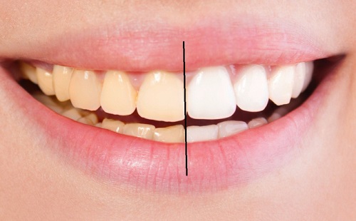 Tẩy trắng răng xong có được đánh răng không? Các lưu ý quan trọng 1