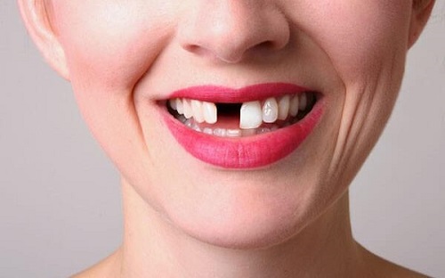 Trồng răng bị rụng - Phương pháp phục hình cho bạn 1