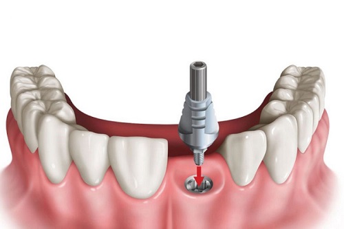Trồng răng bị rụng - Phương pháp phục hình cho bạn 2