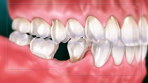 Trồng răng có ảnh hưởng gì không? Tham khảo các tư vấn từ nha khoa 1
