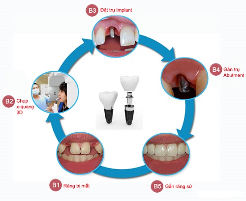 Trồng răng có ảnh hưởng gì không? Tham khảo các tư vấn từ nha khoa 2