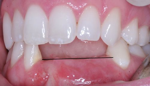 Trồng răng cửa hàm dưới - Giải pháp phục hình cho bạn 1