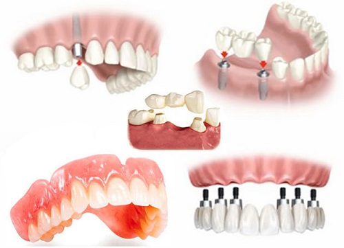 Trồng răng cửa hàm dưới - Giải pháp phục hình cho bạn 2