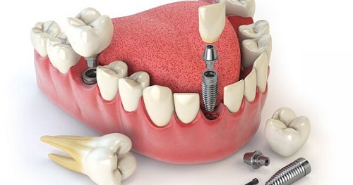 Trồng răng cửa hàm dưới - Giải pháp phục hình cho bạn 3