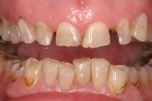 Răng sứ bị mòn - Các nguyên nhân bạn nên biết 2