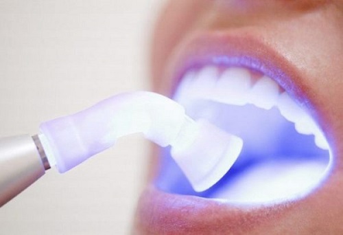 Tẩy trắng răng bằng đèn plasma giá bao nhiêu? Chi phí từ nha khoa 3
