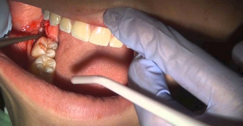 Viêm ổ răng khôn - Nguyên nhân - Biểu hiện - Xử lý 1