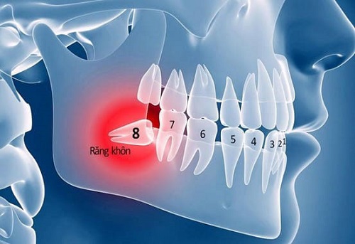 Viêm ổ răng khôn - Nguyên nhân - Biểu hiện - Xử lý 2
